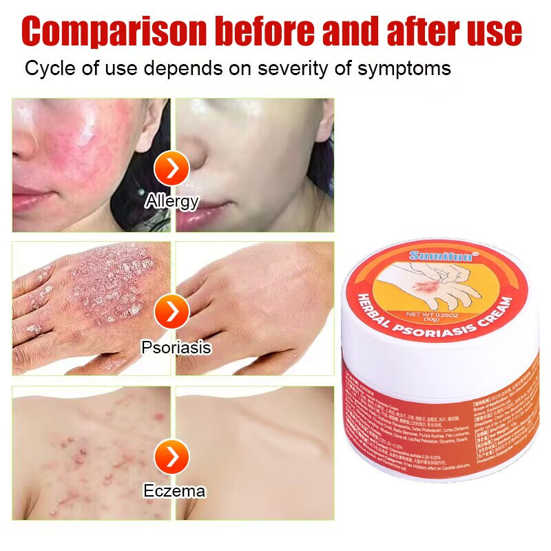 Herbal Psoriasis Cream Dermatitis Eczematoid Treatment Antibacterial