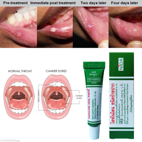 Mouth Ulcer Relief Gel Natural Herbal Oral Antibacterial Cream Fast Relief from Severe Pain & Irritation within 2 minutes