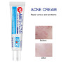 New Effective Acne Removal Cream Clears Blemish Pimple Remover Spot Safe Gentle Remove Acne Acne Cream For Clearing Severe Acne