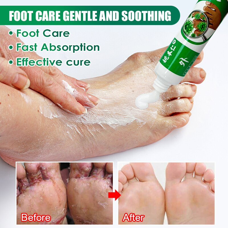 3 Types Foot Antibacterial Cream Beriberi Treatment Antifungal Cream ...