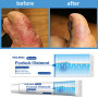 5/10PCS Psoriasis Cream Eczema Ointment Hand Tinea Psoriasis Treatment Foot Odor Versicolor Inhibit Dermatitis Anti-itch Cream