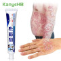 Ointment Treatment Psoriasis Rash Eczema Chinese Herbal Anti-itch Cream Inhibit Fungi Dermatitis Medical Cream S016