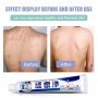 Ointment Treatment Psoriasis Rash Eczema Chinese Herbal Anti-itch Cream Inhibit Fungi Dermatitis Medical Cream S016