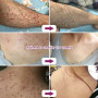 Herbal Acne Treatment Cream Folliculitis Eczema Rash Psoriasis Fungus Removal Skin Care Ointment Relieve Skin