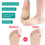 2Pcs Bunion Corrector Toe Separator Protectors Foot Pain Relief Brace for Overlapping Toe Hallux Valgus Foot Care Tool