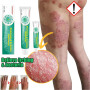 Herbal Antibacterial Cream Psoriasis Cream Itching Relief Eczema Rash Urticaria Scaling Treatment