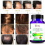 Hair Growth Supplements Prevent Hair Loss for Scalp Treatment Beauty Care Fast Hair Growth Treatment Scalp Essentials