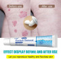 Psoriasis Cream Eczema Ointment Psoriasis Treatment Hand Tinea Foot Odor Versicolor Inhibit Dermatitis Fungus Anti-itch Cream