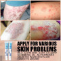Psoriasis Cream Eczema Ointment Psoriasis Treatment Hand Tinea Foot Odor Versicolor Inhibit Dermatitis Fungus Anti-itch Cream