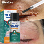 iBeaLee Skin Wart Remover Serum Corn Tag Clean Painless Mole Skin Dark Spot Face Eye Warts Remover Treatment Cream For Men Women